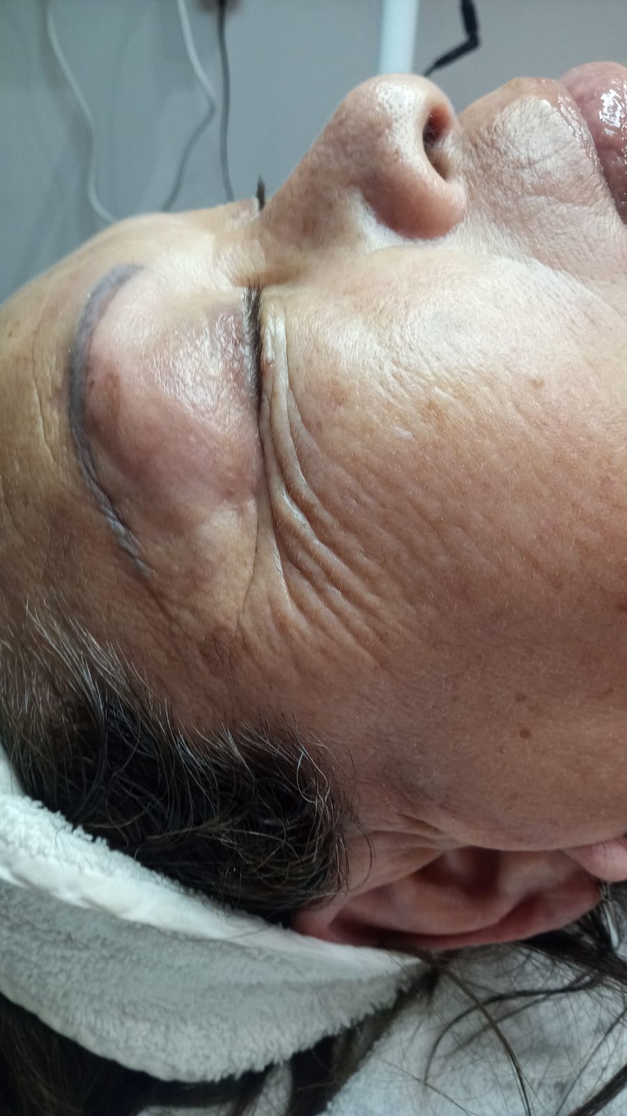 Tratamiento anti-age