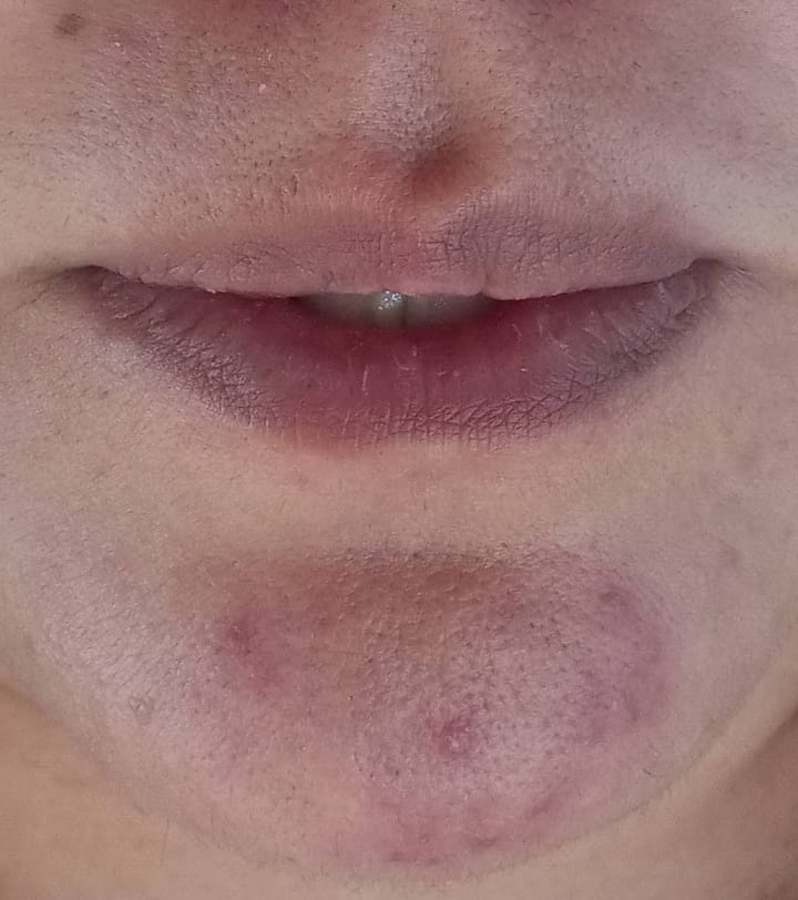 Piel sensible o con rosácea