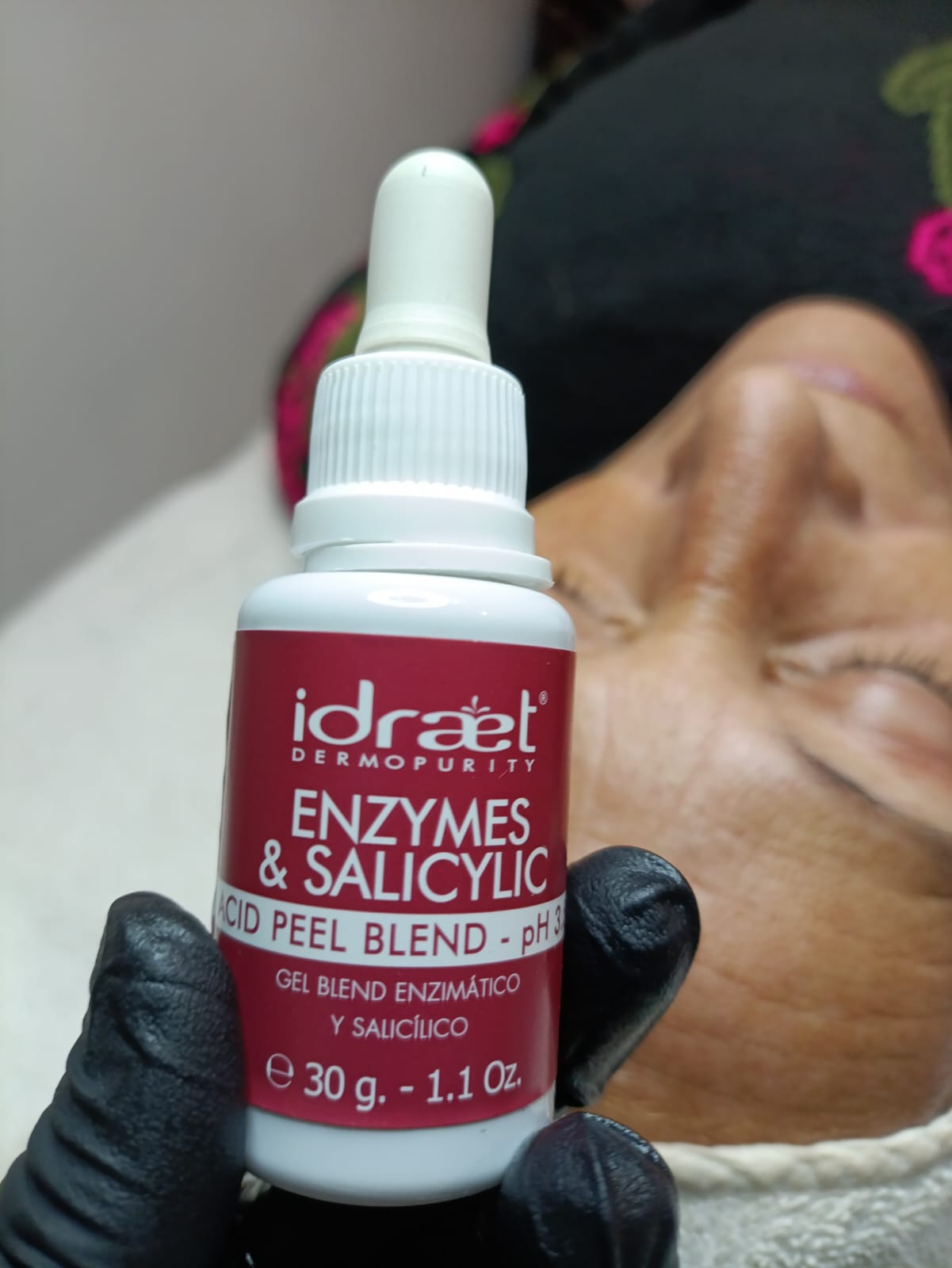 Peeling químico